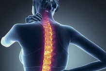 Osteoporosis: Discover the Risk, Causes, Treatment and Prevention